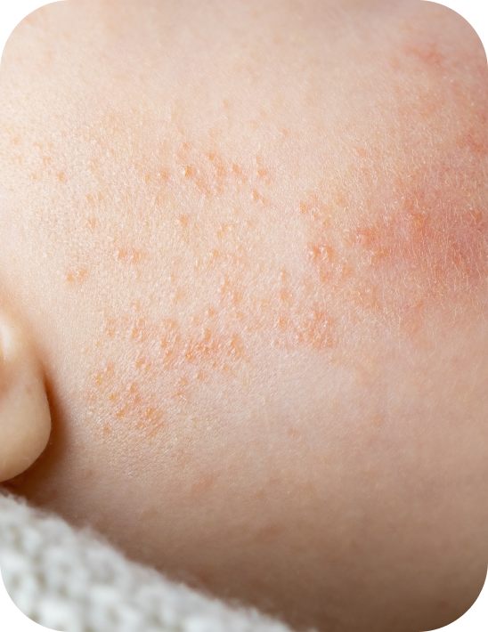 dermatitis